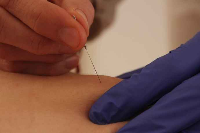 Dry Needling
