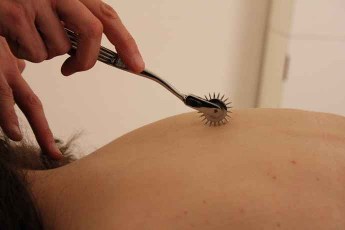 Dry Needling